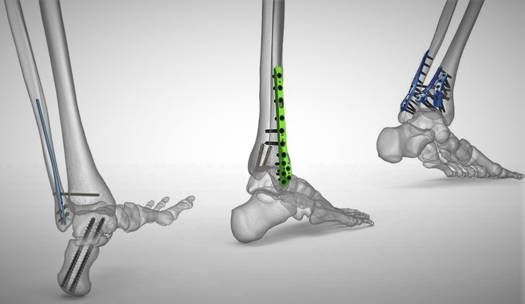 orthopedic implants - HCM Ortho orthopedic implants